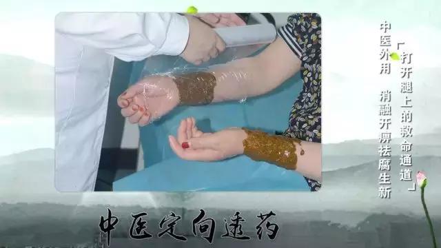 腿腳發涼、發麻？嚴重者可截肢！提醒身邊人警惕這種疾病！