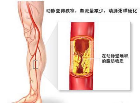 醫生告誡：4個徵兆說明你的血管堵塞，血液粘稠如粥，早送醫，能活命！