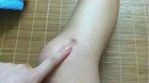 為什麼你的身上會無緣無故出現淤青?這4種情況最要命,一定注意