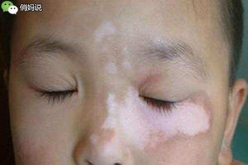 仔細看看，你家小孩臉上有「這種白斑」嗎？這個竟是......