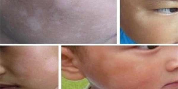 仔細看看，你家小孩臉上有「這種白斑」嗎？這個竟是......