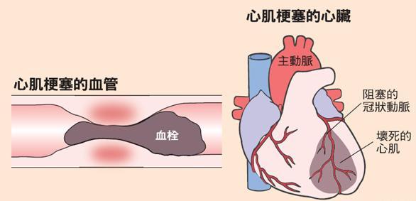 醫生告誡：4個徵兆說明你的血管堵塞，血液粘稠如粥，早送醫，能活命！