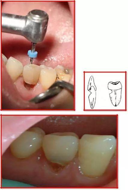 你還在用這種方式刷牙嗎？這樣刷牙會「刷掉」牙齒！已經有人中招！