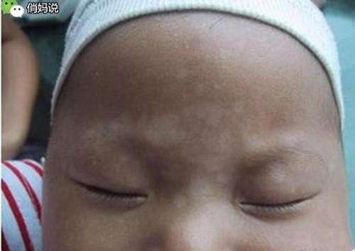 仔細看看，你家小孩臉上有「這種白斑」嗎？這個竟是......