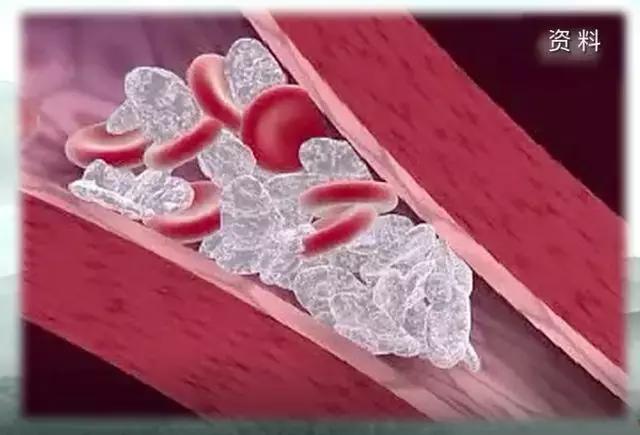 腿腳發涼、發麻？嚴重者可截肢！提醒身邊人警惕這種疾病！