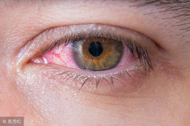 早上起床眼乾、眼屎多,可能預示5種病!希望你別等出事才發現