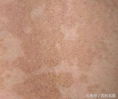 脖子黑洗不淨需注意！這是「黑棘皮症」，恐是大病征兆！