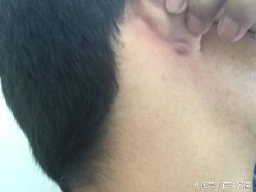 耳朵後麵長了個硬包是怎麼回事？專家說：要當心這幾種情況！