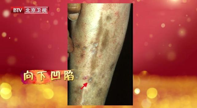 腿上有這種斑，當心糖尿病脛前色素斑！保護腿足，這些方法很實用