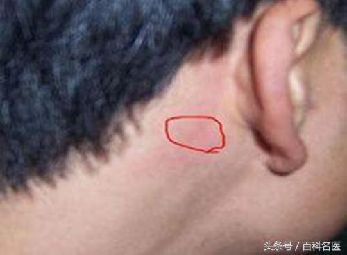 耳朵後麵長了個硬包是怎麼回事？專家說：要當心這幾種情況！