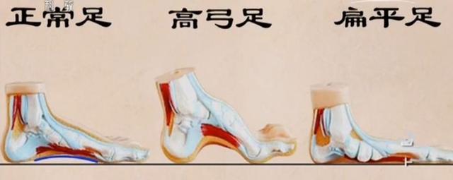 腳後跟痛、腳底長繭是病!簡單幾招,不用花錢,趕走疼痛!