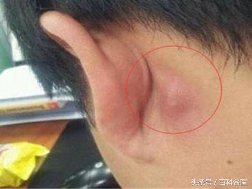 耳朵後麵長了個硬包是怎麼回事？專家說：要當心這幾種情況！