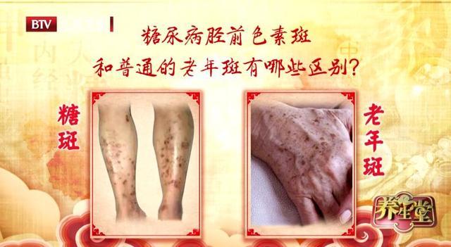 腿上有這種斑，當心糖尿病脛前色素斑！保護腿足，這些方法很實用