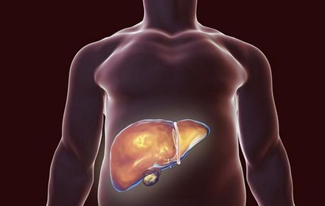 肝病多半是吃出來的，營養師：想肝髒健康，少吃4類食物