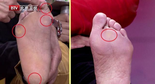 腳後跟痛、腳底長繭是病!簡單幾招,不用花錢,趕走疼痛!