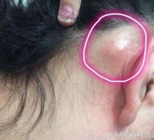 耳朵後麵長了個硬包是怎麼回事？專家說：要當心這幾種情況！