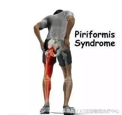 「醫生，我久坐腰不疼，但是腿麻屁股疼是怎麼回事？」