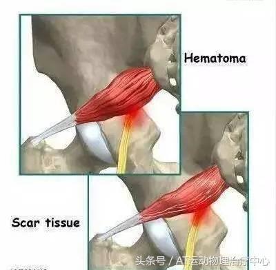 「醫生，我久坐腰不疼，但是腿麻屁股疼是怎麼回事？」