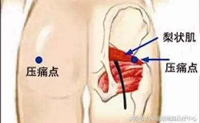 「醫生，我久坐腰不疼，但是腿麻屁股疼是怎麼回事？」