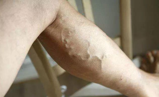 泡腳雖好，但是這6種人不能隨便泡！