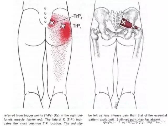 「醫生，我久坐腰不疼，但是腿麻屁股疼是怎麼回事？」