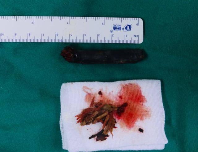 8歲男孩嘴裡這東西腐爛發黑！醫生都驚呆了！