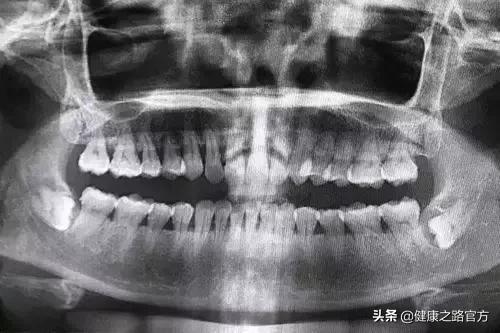 拔智齒能瘦臉？關於智齒的4個真相，拔不拔看這篇就夠了