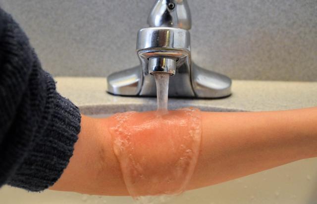 流鼻血的時候，到底是低頭好還是仰頭好？注意：選錯很危險