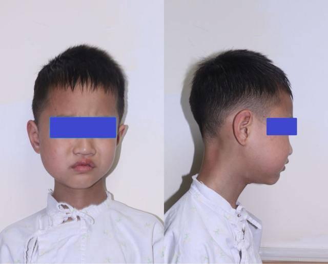8歲男孩嘴裡這東西腐爛發黑！醫生都驚呆了！