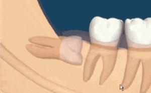 拔智齒能瘦臉？關於智齒的4個真相，拔不拔看這篇就夠了