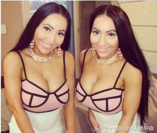 雙胞胎花百萬整容成一模一樣,嫁給同一個男人同步懷孕,現怎樣了