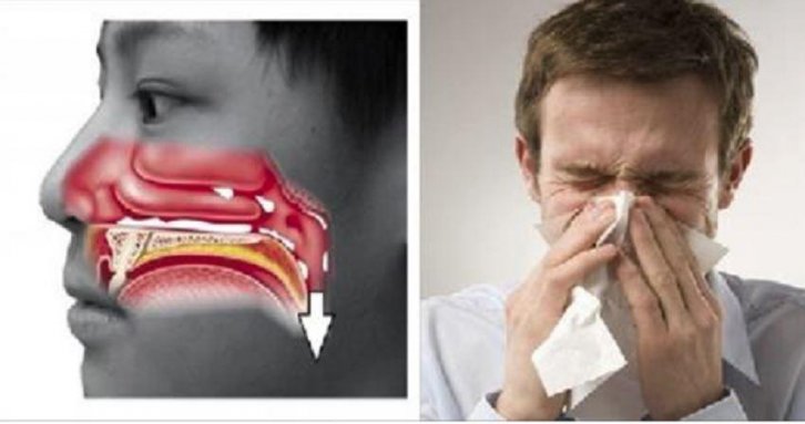耳鼻喉科医师提供「改善鼻涕倒流的五大方法」,你只需要准备一杯温水