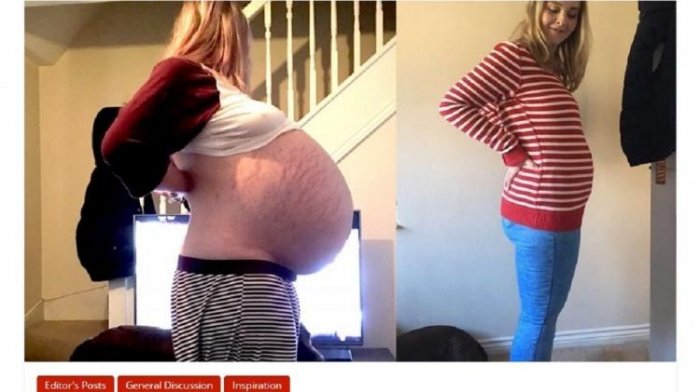 英婦女肚皮脹大近40公分...X光一照醫師大驚：竟藏「7個嬰兒」！網開眼界：不可思議