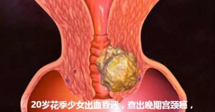 宫颈癌的早期出血图片图片